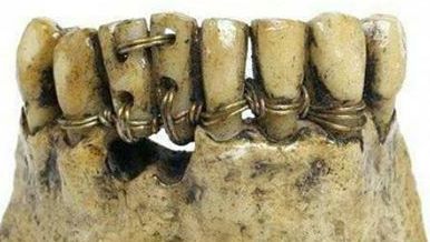 protesi_etruscan